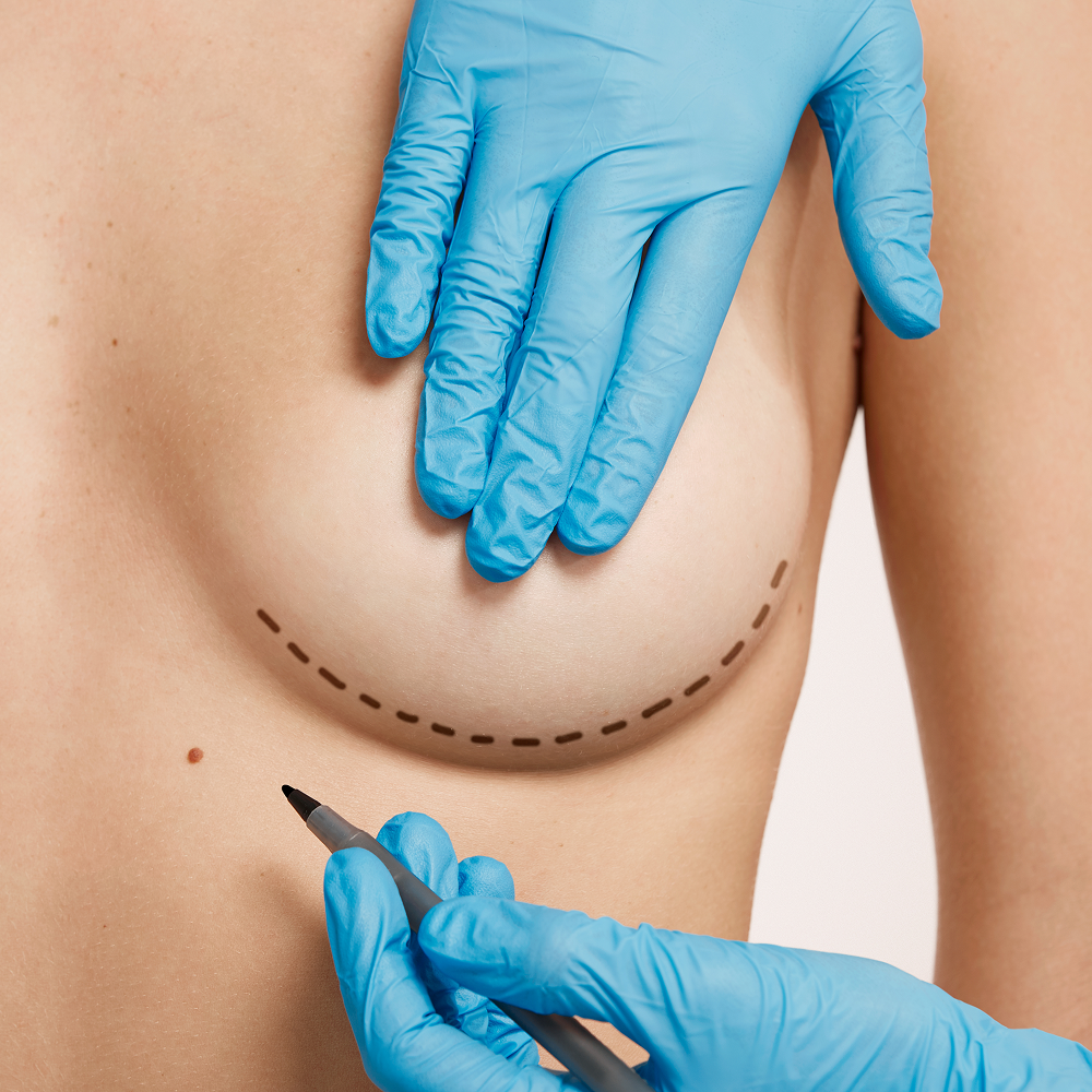 Breast Implants – Your Guide to Size, Safety, and Satisfaction